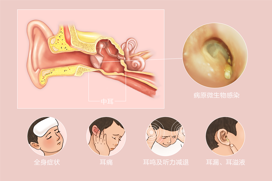 流感肆虐,中耳炎患者要注意了